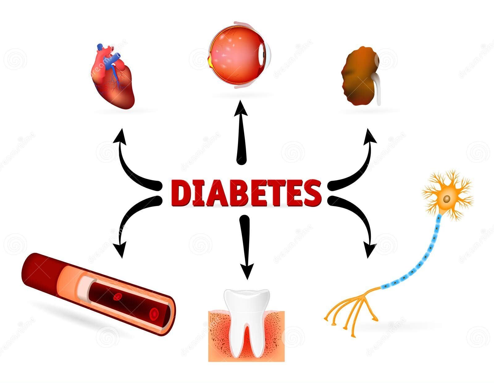 Diabetes mellitus 1