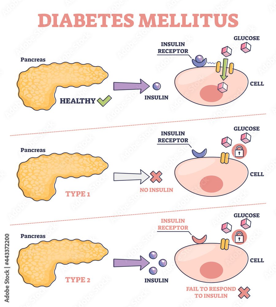 Type 1 diabetes 