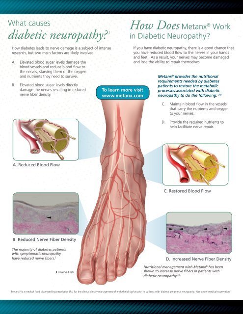 Diabetic neuropathy